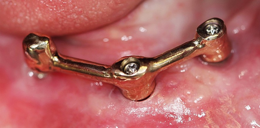 Implantologische Versorgung in Ausnahmefällen