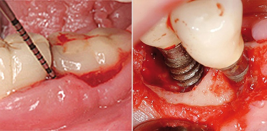 Prävalenz der periimplantären Entzündungen und ihre Behandlung