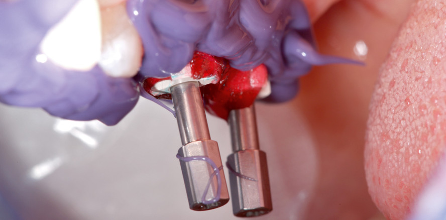 Beseitigung einer Freiendsituation im Oberkiefer