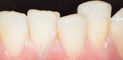 Interdentalraumhygiene – Hilfsmittel und Techniken