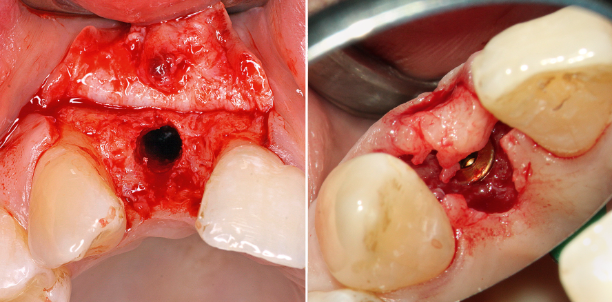 Frontzahnimplantat bei starkem Knochenabbau