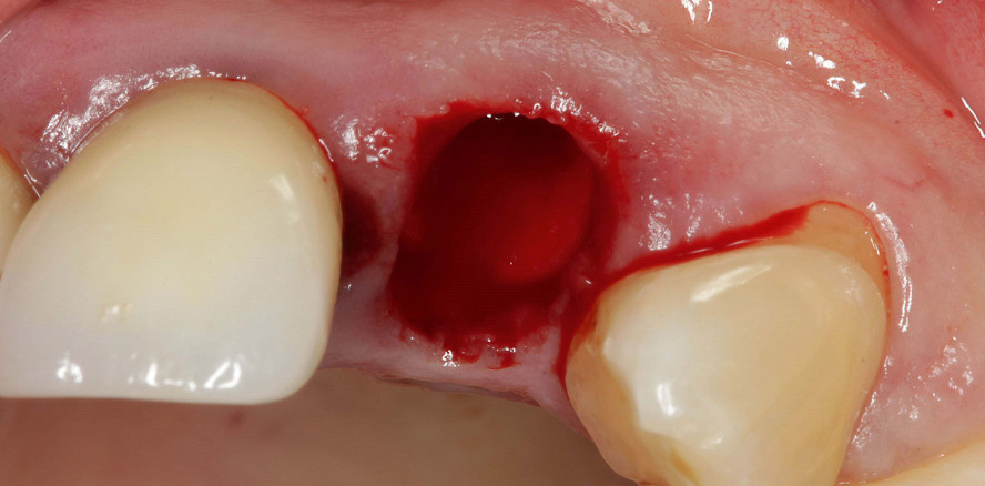 Frontzahnlücke mit vestibulärem Knochendefizit