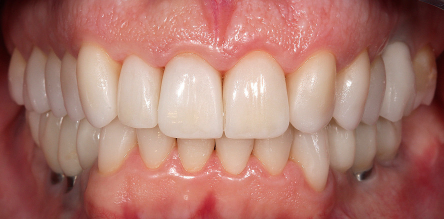 Ästhetisch rekonstruktive Full-Mouth-Rehabilitation