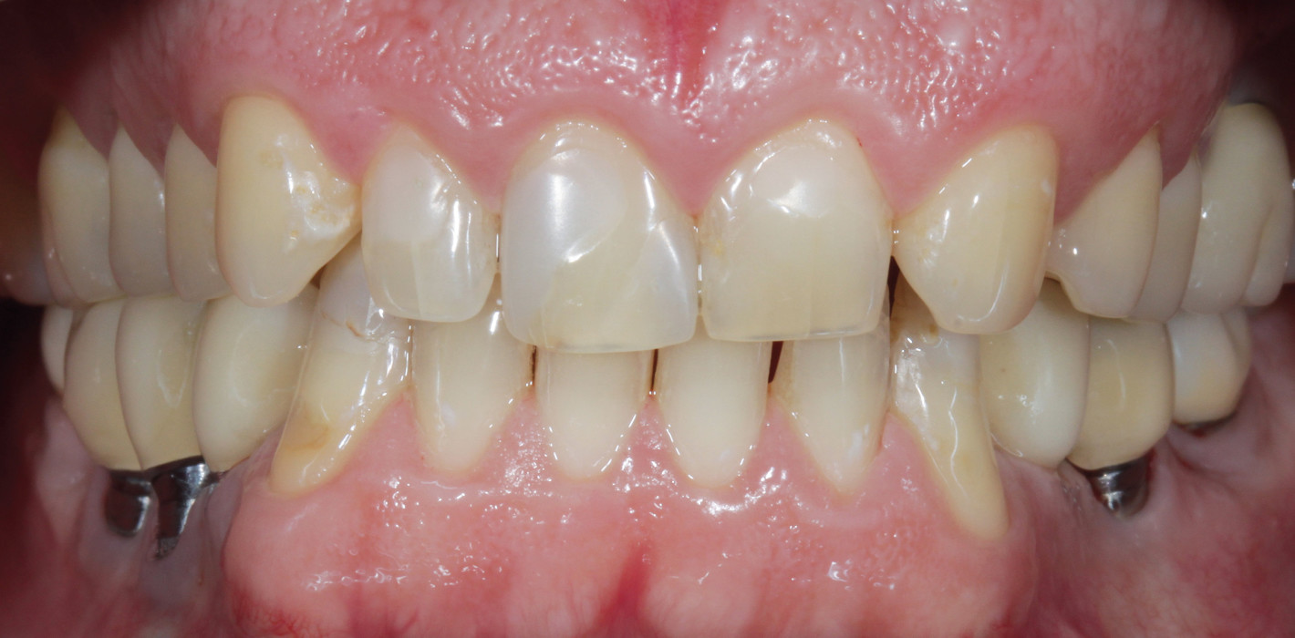 Fallbericht: Adhäsive Full-Mouth-Rehabilitation