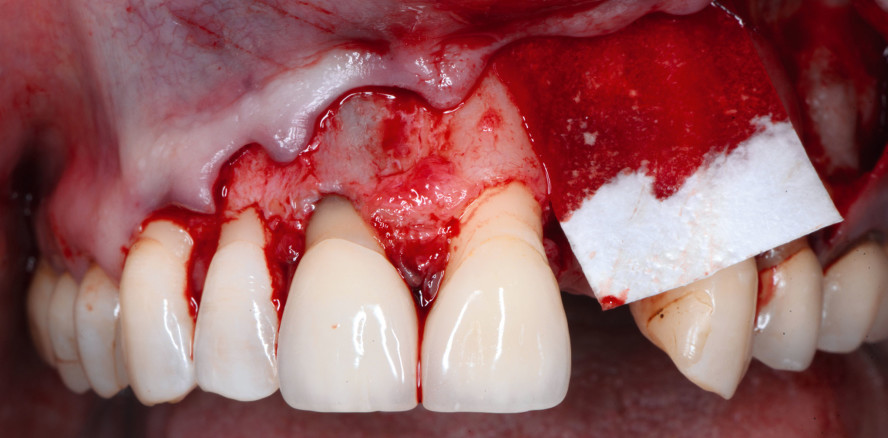 GBR-Behandlungsprognose mit Membranen verbessern