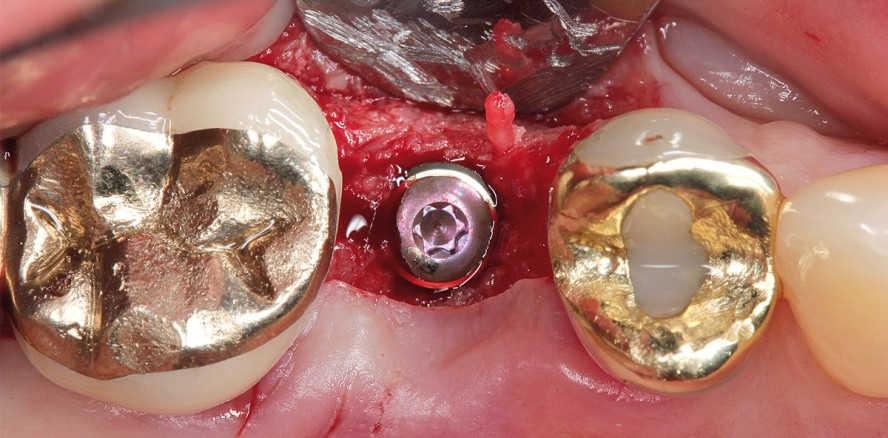 Die vereinfachte augmentative Versorgung der Extraktionsaveole