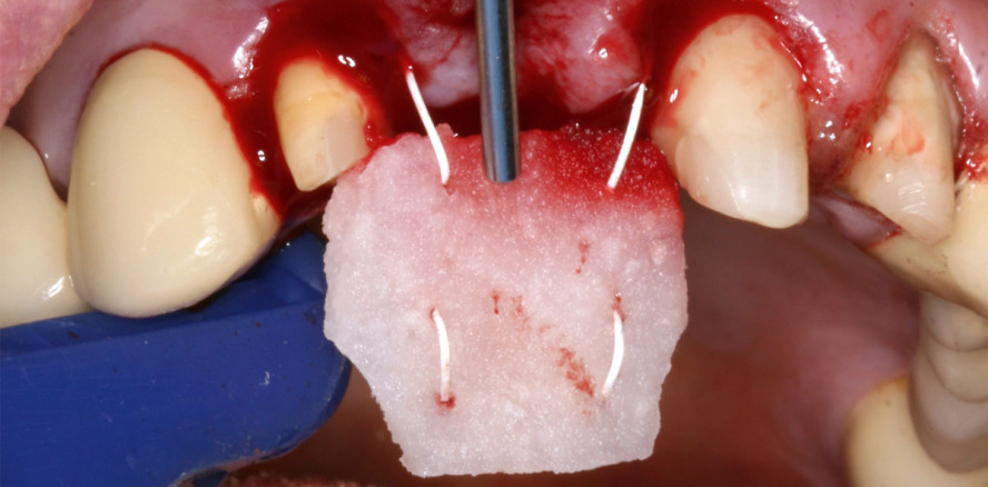3-D-Kollagenmatrix im Fokus