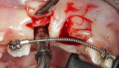 Gemination im Frontzahnbereich: Zahntransplantation als Therapieoption