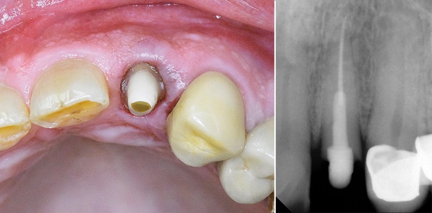 Mit Glasfaserstiften Grenzfälle meistern