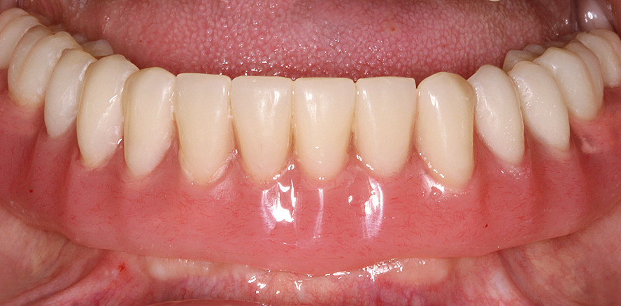 Geführte Sofortimplantation und -versorgung im Unterkiefer