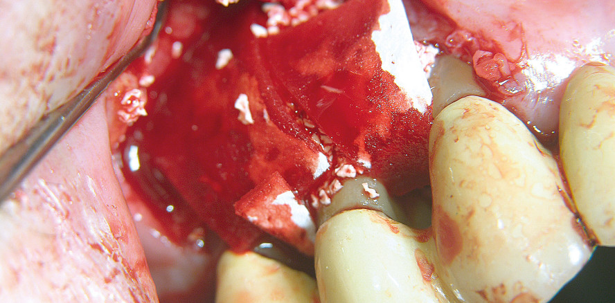 GTR zur Rehabilitation eines tiefen, dreidimensionalen Knochendefekts