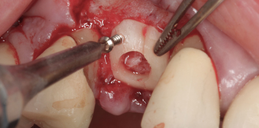 Hangar-Technik bei vertikalem Knochendefekt im Oberkiefer