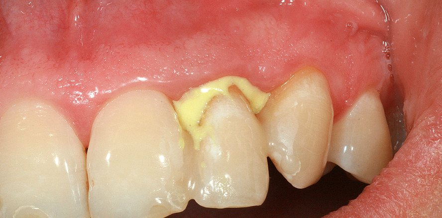 Parodontitisbehandlung: Lokalantibiotikum als Therapieergänzung