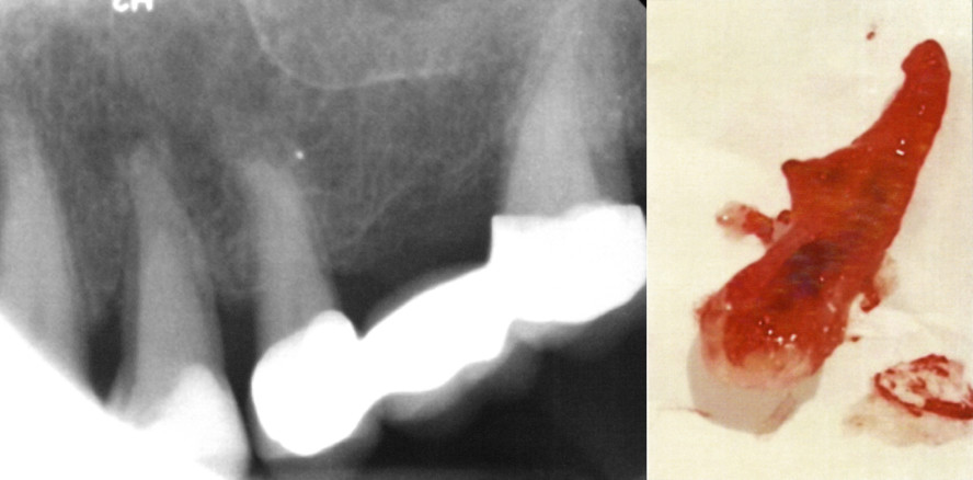 „Hemisektion“ eines oberen ersten Prämolaren