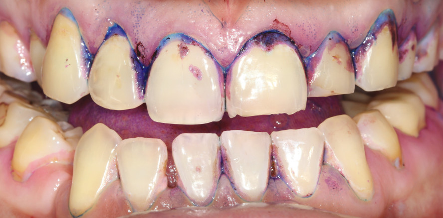 Prävention parodontaler Erkrankungen