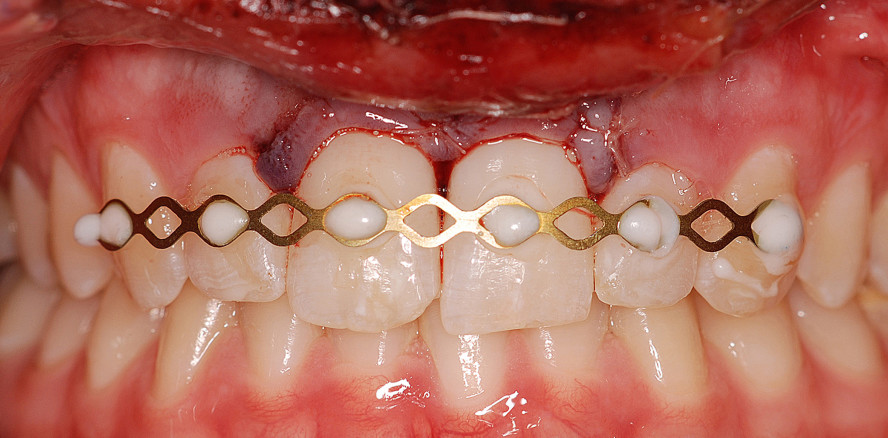 Externe Wurzelresorptionen nach Avulsion