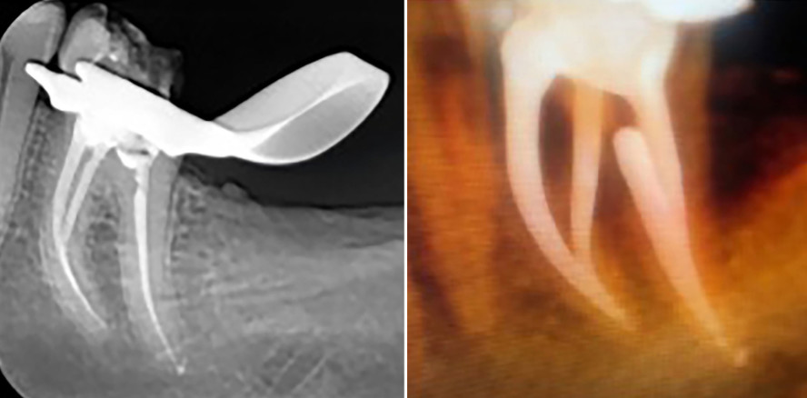 Hybridisierende Wärmebehandlung in der Endodontie