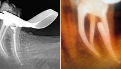 Hybridisierende Wärmebehandlung in der Endodontie