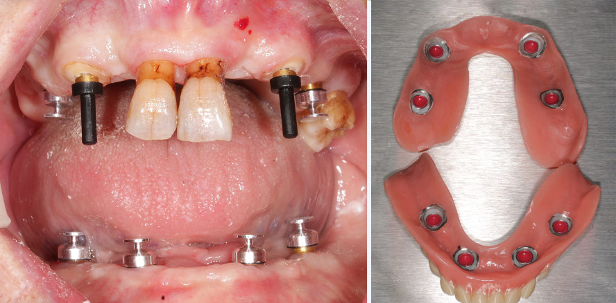 Hybridversorgung mit herausnehmbarer Prothetik und Wurzelstift
