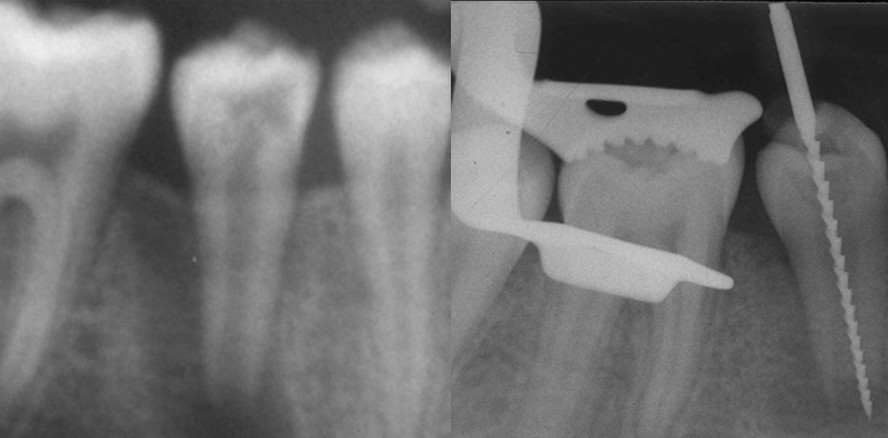 Adhäsivtechnik und hydraulische Kalziumsilikatzemente