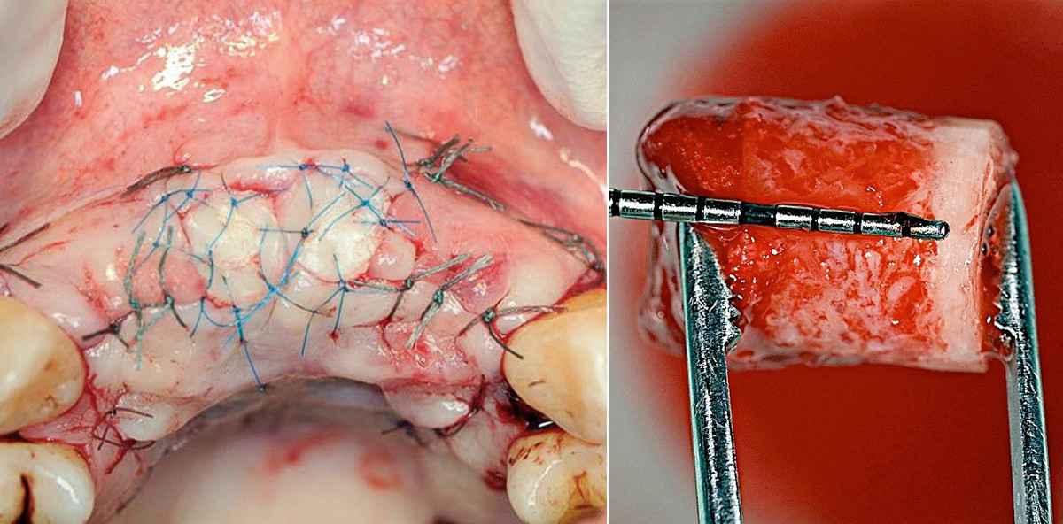 Knochenersatzmaterialien und periimplantärer Knochen