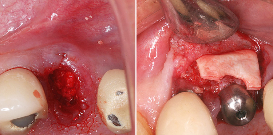 Minimalinvasive Möglichkeit der Ridge Preservation