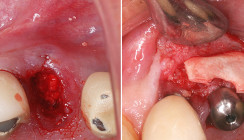 Minimalinvasive Möglichkeit der Ridge Preservation