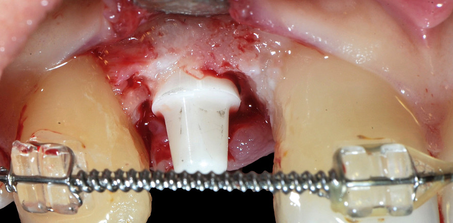 Periimplantäre Weichgewebsvermehrung um ZrO2-Implantate