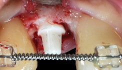 Periimplantäre Weichgewebsvermehrung um ZrO2-Implantate