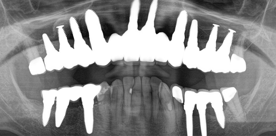 Biologische GBR und Keramikimplantate – Teil 1