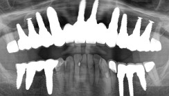 Biologische GBR und Keramikimplantate – Teil 1