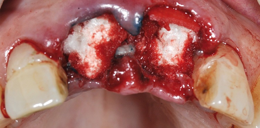 Gesteuerte Knochenregeneration – „One Time Therapy“