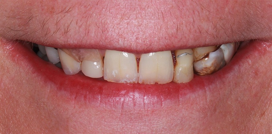 Ästhetische Rehabilitation im parodontal geschädigten Gebiss