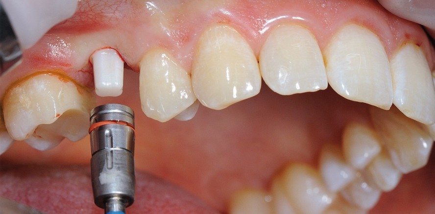 Möglichkeiten und Grenzen von Keramikimplantaten