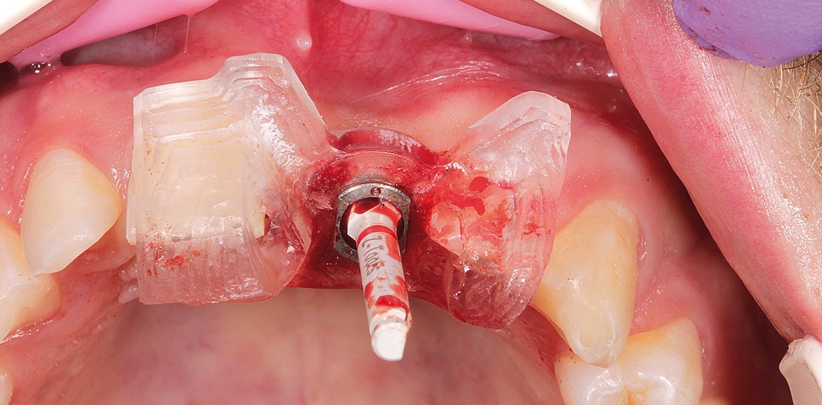 Schablonenunterstützte Insertion eines Keramikimplantats