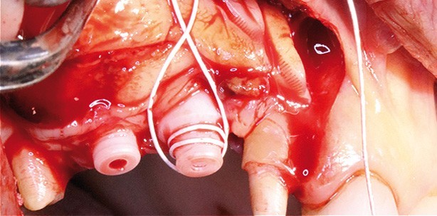 Bone Management und Keramikimplantate