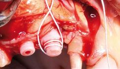 Bone Management und Keramikimplantate