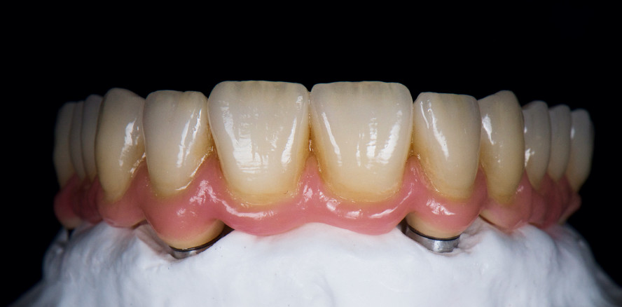  Vom Prototypen zur definitiven Full-Arch-Brücke auf vier Implantaten