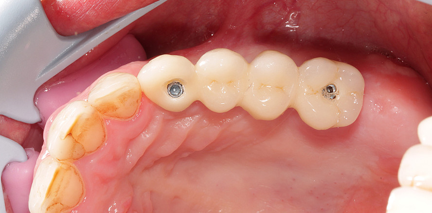 Hybridbrückenrestaurationen auf Implantaten