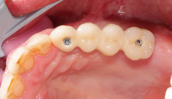 Hybridbrückenrestaurationen auf Implantaten