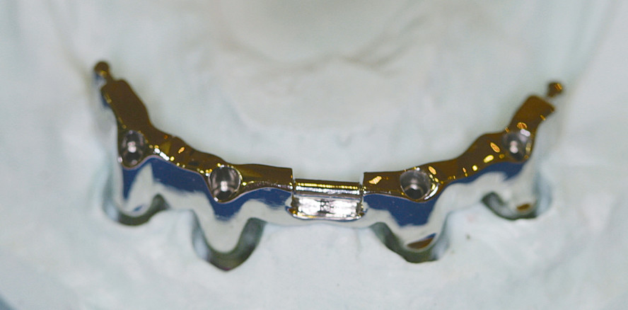 Implantatgetragene Stegversorgung im Unterkiefer