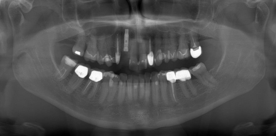 Einfluss biologischer und technischer Faktoren auf den Implantaterfolg