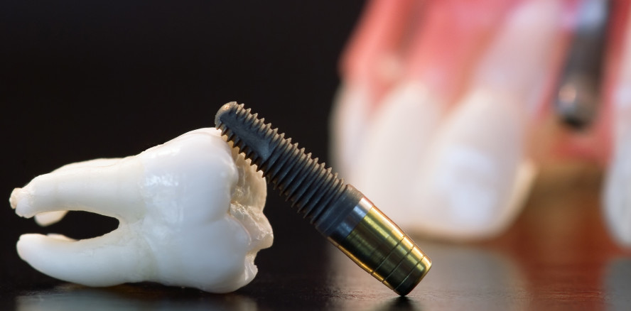 Implantoplastik: Welche Komplikationen können auftreten?