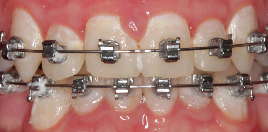 Einfache und effektive Umsetzung der Karies- und Gingivitisprävention in der KFO