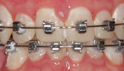 Einfache und effektive Umsetzung der Karies- und Gingivitisprävention in der KFO