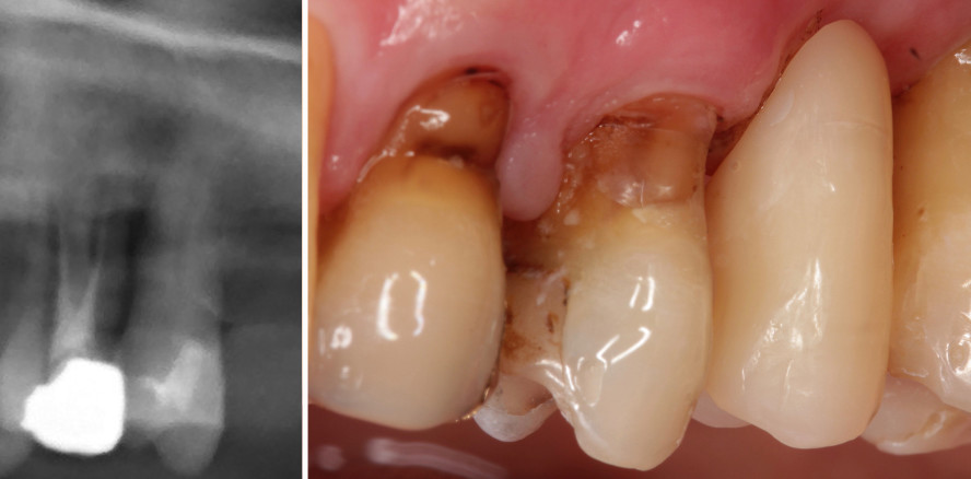 Prothetische Versorgung mit Blick auf den parodontalen Status