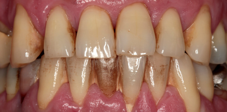 Gingivale Biotypen: Einfluss auf parodontale Erkrankungen