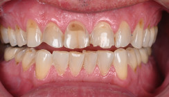 Keine Grenzen mit Komposit – eine umfassende orale Rehabilitation