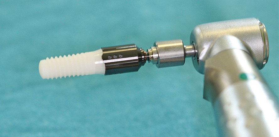 Der Einsatz von einteiligen Keramikimplantaten im Praxisalltag