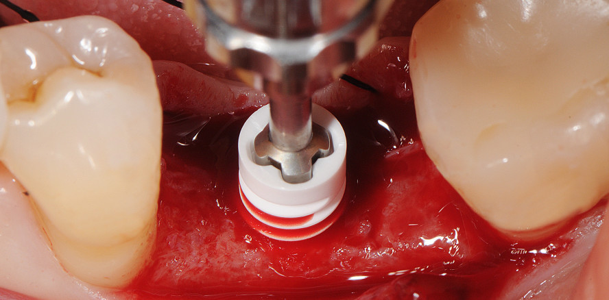Next Generation – das zweiteilig verschraubte Keramikimplantat